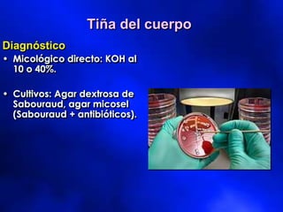 Tiña del cuerpo
Diagnóstico
• Micológico directo: KOH al
10 o 40%.
• Cultivos: Agar dextrosa de
Sabouraud, agar micosel
(Sabouraud + antibióticos).
 