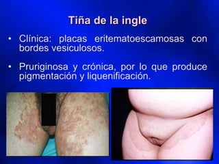 • Clínica: placas eritematoescamosas con
bordes vesiculosos.
• Pruriginosa y crónica, por lo que produce
pigmentación y liquenificación.
Tiña de la ingle
 