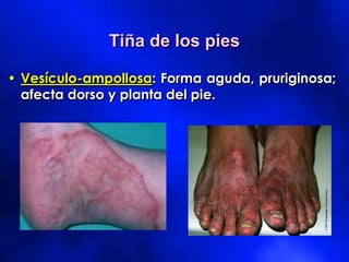 • Vesículo-ampollosa: Forma aguda, pruriginosa;
afecta dorso y planta del pie.
Tiña de los pies
 