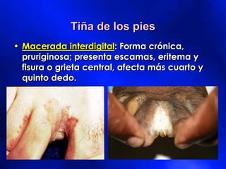 Tiña de los pies
• Macerada interdigital: Forma crónica,
pruriginosa; presenta escamas, eritema y
fisura o grieta central, afecta más cuarto y
quinto dedo.
 