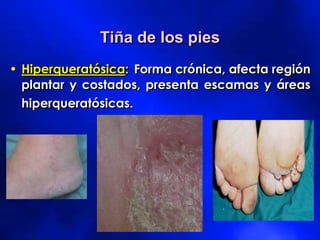 Tiña de los pies
• Hiperqueratósica: Forma crónica, afecta región
plantar y costados, presenta escamas y áreas
hiperqueratósicas.
 