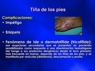 Tiña de los pies
Complicaciones:
• Impétigo
• Erisipela
• Fenómeno de Ide o dermatofítide (tricofítide):
son erupciones secundarias que se presentan en pacientes
sensibilizados como respuesta a una diseminación hematógena
del hongo o sus productos alergénicos desde el foco primario;
más frecuente en manos, depende de las tiñas de los pies, y se
manifiesta por vesículas (dishidrosis), descamación y prurito.
 