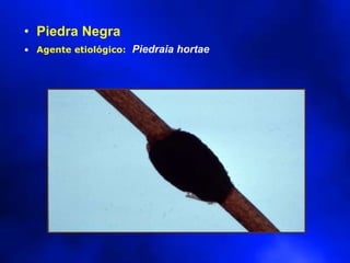 • Piedra Negra
• Agente etiológico: Piedraia hortae
 