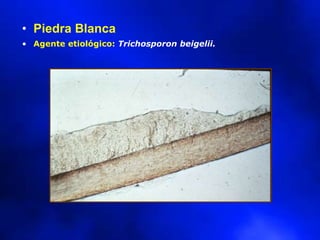 • Piedra Blanca
• Agente etiológico: Trichosporon beigelii.
 