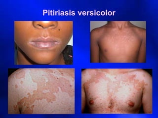 Pitiriasis versicolor
 