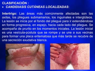 CLASIFICACIÓN :
• CANDIDIASIS CUTÁNEAS LOCALIZADAS:
Intertrigo: Las áreas más comúnmente afectadas son las
axilas, los pliegues submamarios, los inguinales e interglúteos.
La lesión se inicia por el fondo del pliegue para ir extendiéndose
en forma progresiva, en espejo, hacia cada lado del pliegue. Se
acompaña de prurito en los momentos iniciales. La lesión inicial
es una vesícula-pústula que se rompe y se une a sus vecinas
para formar una placa eritematosa que más tarde se recubre de
una secreción exudativa blanca.
 