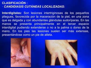 CLASIFICACIÓN :
· CANDIDIASIS CUTÁNEAS LOCALIZADAS:
Interdigitales: Son lesiones intertriginosas de los pequeños
pliegues, favorecida por la maceración de la piel, en una zona
que es delgada y con abundantes glándulas sudoríparas. En las
manos se presenta principalmente en el tercer espacio
interdigital pudiendo extenderse o no a la palma o dorso de la
mano. En los pies las lesiones suelen ser más extensas,
presentándose como un pie de atleta.
 