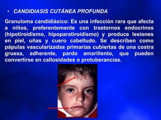 • CANDIDIASIS CUTÁNEA PROFUNDA
Granuloma candidiásico: Es una infección rara que afecta
a niños, preferentemente con trastornos endocrinos
(hipotiroidismo, hipoparatiroidismo) y produce lesiones
en piel, uñas y cuero cabelludo. Se describen como
pápulas vascularizadas primarias cubiertas de una costra
gruesa, adherente, pardo amarillento, que pueden
convertirse en callosidades o protuberancias.
 