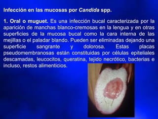 Infección en las mucosas por Candida spp.
1. Oral o muguet. Es una infección bucal caracterizada por la
aparición de manchas blanco-cremosas en la lengua y en otras
superficies de la mucosa bucal como la cara interna de las
mejillas o el paladar blando. Pueden ser eliminadas dejando una
superficie sangrante y dolorosa. Estas placas
pseudomembranosas están constituidas por células epiteliales
descamadas, leucocitos, queratina, tejido necrótico, bacterias e
incluso, restos alimenticios.
 