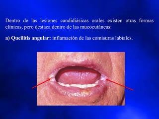 Dentro de las lesiones candidiásicas orales existen otras formas
clínicas, pero destaca dentro de las mucocutáneas:
a) Queilitis angular: inflamación de las comisuras labiales.
 