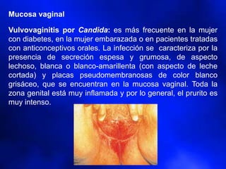 Mucosa vaginal
Vulvovaginitis por Candida: es más frecuente en la mujer
con diabetes, en la mujer embarazada o en pacientes tratadas
con anticonceptivos orales. La infección se caracteriza por la
presencia de secreción espesa y grumosa, de aspecto
lechoso, blanca o blanco-amarillenta (con aspecto de leche
cortada) y placas pseudomembranosas de color blanco
grisáceo, que se encuentran en la mucosa vaginal. Toda la
zona genital está muy inflamada y por lo general, el prurito es
muy intenso.
 
