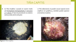 Endotrix Micosis superficiales.pptx