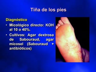 Diagnóstico
• Micológico directo: KOH
al 10 o 40%.
• Cultivos: Agar dextrosa
de Sabouraud, agar
micosel (Sabouraud +
antibióticos)
Tiña de los pies
 
