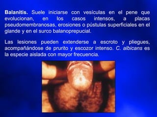 Balanitis. Suele iniciarse con vesículas en el pene que
evolucionan, en los casos intensos, a placas
pseudomembranosas, erosiones o pústulas superficiales en el
glande y en el surco balanoprepucial.
Las lesiones pueden extenderse a escroto y pliegues,
acompañándose de prurito y escozor intenso. C. albicans es
la especie aislada con mayor frecuencia.
 