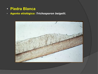 • Piedra Blanca
• Agente etiológico: Trichosporon beigelii.
 
