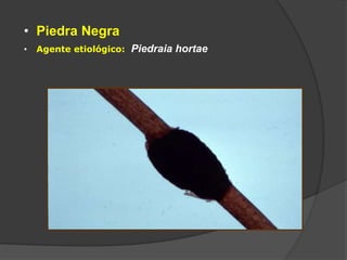 • Piedra Negra
• Agente etiológico: Piedraia hortae
 