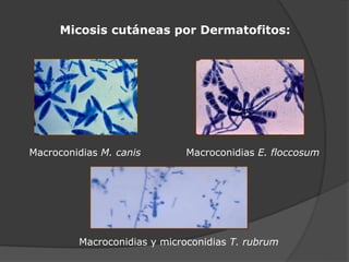 Micosis cutáneas por Dermatofitos:
Macroconidias M. canis Macroconidias E. floccosum
Macroconidias y microconidias T. rubrum
 