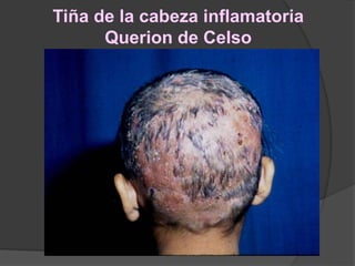 Tiña de la cabeza inflamatoria
Querion de Celso
 