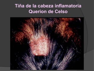 Tiña de la cabeza inflamatoria
Querion de Celso
 