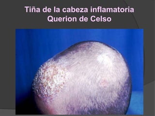 Tiña de la cabeza inflamatoria
Querion de Celso
 
