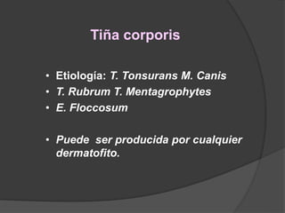 Tiña corporis
• Etiología: T. Tonsurans M. Canis
• T. Rubrum T. Mentagrophytes
• E. Floccosum
• Puede ser producida por cualquier
dermatofito.
 