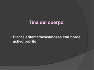 Tiña del cuerpo
• Placas eritematoescamosas con borde
activo prúrito
 