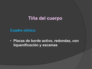 Tiña del cuerpo
Cuadro clínico:
• Placas de borde activo, redondas, con
liquenificación y escamas
 
