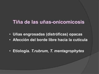 Tiña de las uñas-onicomicosis
• Uñas engrosadas (distróficas) opacas
• Afección del borde libre hacia la cutícula
• Etiología. T.rubrum, T. mentagrophytes
 