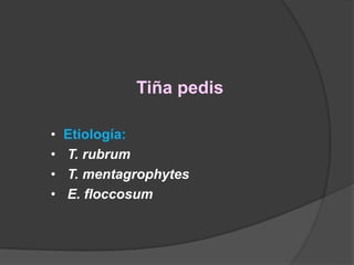 Tiña pedis
• Etiología:
• T. rubrum
• T. mentagrophytes
• E. floccosum
 