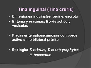 Tiña inguinal (Tiña cruris)
• En regiones inguinales, perine, escroto
• Eritema y escamas; Borde activo y
vesículas
• Placas eritematoescamosas con borde
activo uni o bilateral prúrito
• Etiología: T. rubrum, T. mentagrophytes
E. floccosum
 