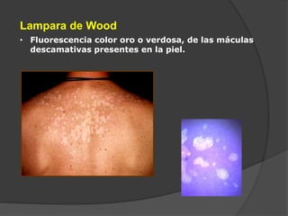 Lampara de Wood
• Fluorescencia color oro o verdosa, de las máculas
descamativas presentes en la piel.
 