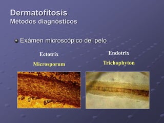 Endotrix Micosis+Superficiales.ppt