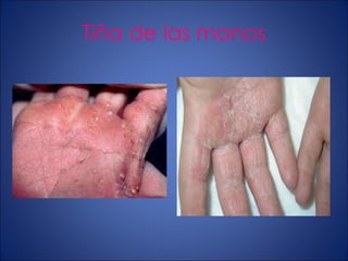 Tiña de las manos 