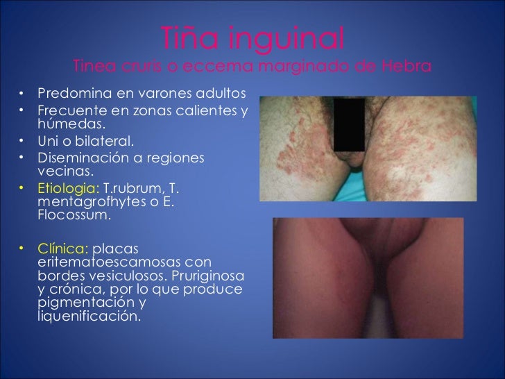 Por que se desarrolla la psoriasis