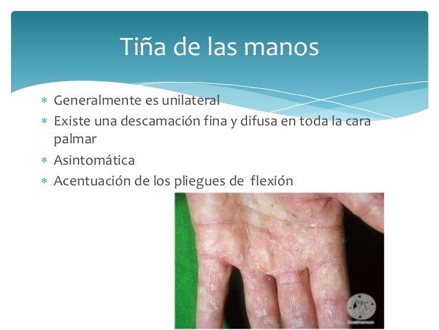 La crema con la vitamina d y las hormonas de la psoriasis