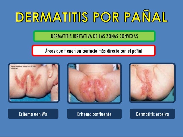 Neyrodermit de las fotos adultas