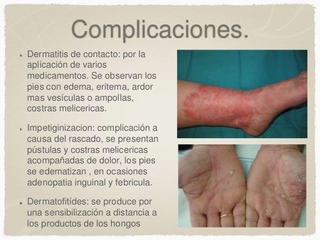 El ajo de la psoriasis sobre las uñas