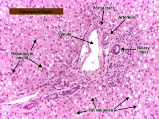 Patologia de Fígado
 