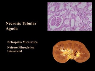 Necrosis Tubular
Aguda
Nefropatia Micotoxica
Nefrose Fibrocistica
Intersticial
 