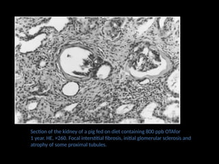 Section of the kidney of a pig fed on diet containing 800 ppb OTAfor
1 year. HE, ×260. Focal interstitial fibrosis, initial glomerular sclerosis and
atrophy of some proximal tubules.
 