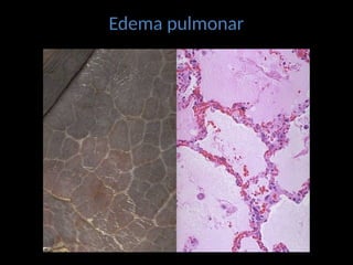 Edema pulmonar
 