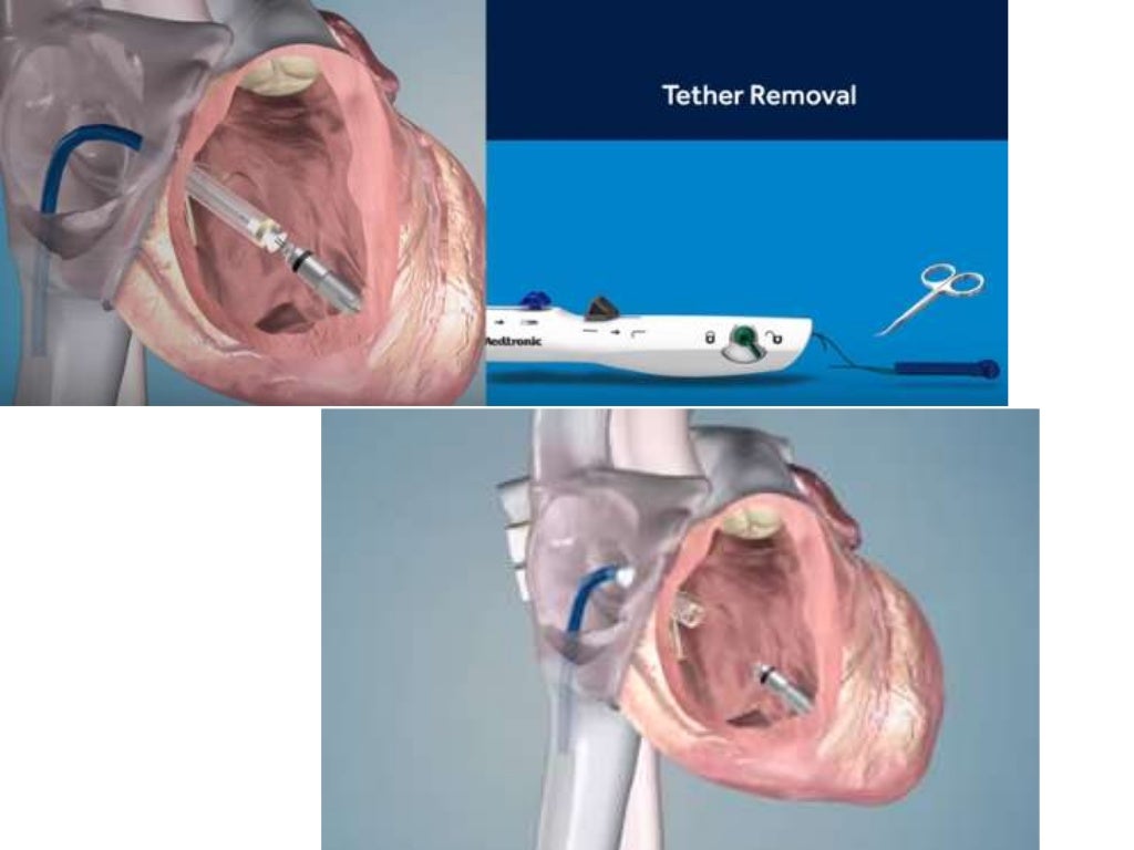 Micra wireless permanent pacemaker
