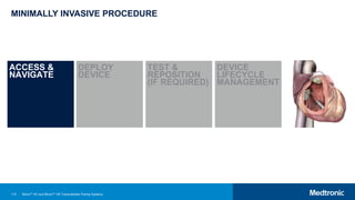 110
MINIMALLY INVASIVE PROCEDURE
ACCESS &
NAVIGATE
DEPLOY
DEVICE
TEST &
REPOSITION
(IF REQUIRED)
DEVICE
LIFECYCLE
MANAGEMENT
Micra™ AV and Micra™ VR Transcatheter Pacing Systems
 