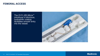 111
FEMORAL ACCESS
The 23 Fr (ID) Micra™
introducer’s lubricious,
hydrophilic coating
facilitates smooth entry
into the vessel.
Micra™ AV and Micra™ VR Transcatheter Pacing Systems
 