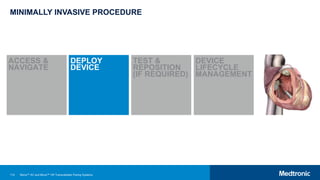 112
MINIMALLY INVASIVE PROCEDURE
ACCESS &
NAVIGATE
DEPLOY
DEVICE
TEST &
REPOSITION
(IF REQUIRED)
DEVICE
LIFECYCLE
MANAGEMENT
Micra™ AV and Micra™ VR Transcatheter Pacing Systems
 