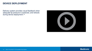 114
DEVICE DEPLOYMENT
Delivery system provides visual feedback when
adequate tip pressure is achieved, and retracts
during device deployment.16
Micra™ AV and Micra™ VR Transcatheter Pacing Systems
 