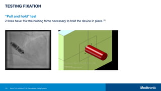 116
TESTING FIXATION
“Pull and hold” test
2 tines have 15x the holding force necessary to hold the device in place.20
Micra™ AV and Micra™ VR Transcatheter Pacing Systems
 