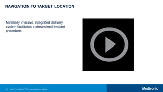 119
NAVIGATION TO TARGET LOCATION
Minimally invasive, integrated delivery
system facilitates a streamlined implant
procedure.
Micra™ AV and Micra™ VR Transcatheter Pacing Systems
 