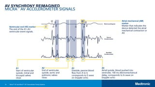 14
AV SYNCHRONY REIMAGINED
MICRA™ AV ACCELEROMETER SIGNALS
A1
Start of ventricular
systole, mitral and
tricuspid valves
close.
A2
End of ventricular
systole, aortic and
pulmonic valves
close.
A3
Diastole, passive blood
flow from A to V,
corresponds to E-wave
on Doppler echo.
A4
Atrial systole, blood pushed into
ventricles, 100 ms electromechanical
delay, corresponds to A-wave on
Doppler echo.
Ventricular end (VE) marker
The end of the A1–A3
ventricular-event signals.
Atrial mechanical (AM)
marker
Marker that indicates the
device detected the atrial
mechanical contraction or
A4.
Micra™ AV and Micra™ VR Transcatheter Pacing Systems
 