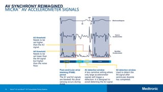 15
AV SYNCHRONY REIMAGINED
MICRA™ AV ACCELEROMETER SIGNALS
Post-ventricular atrial
blanking (PVAB)
period
The A1 and A2 signals
are blanked. No atrial
sensing occurs during
PVAB.
A3 detection window
A less-sensitive setting where
only large accelerometer
signals will trigger a
detection. It is designed to
avoid detecting the A3 signal.
A3 threshold
Needs to be
set higher
than the A3
signal.
A4 detection window
Used to detect the
A4 signal after
ventricular diastole
has completed.
A4 threshold
Needs to be
set lower than
the A4 signal
but higher
than the noise
floor.
Micra™ AV and Micra™ VR Transcatheter Pacing Systems
 